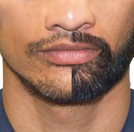 Beard Transplant Solutions