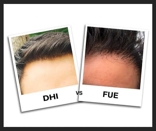 FUE & DHI Hair Transplant