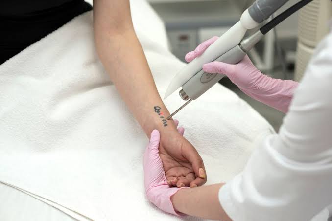 Tattoo Removal