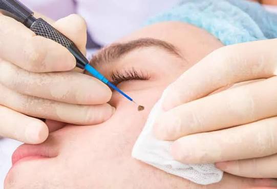 Wart Removal